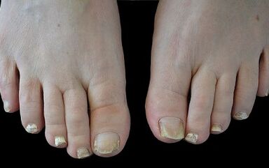 Hogyan lehet megszabadulni az ujjain lévő gomba