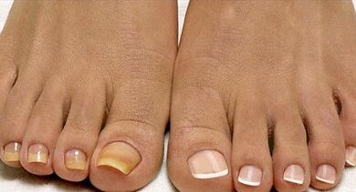 Flotta gomba kezelési módszerei