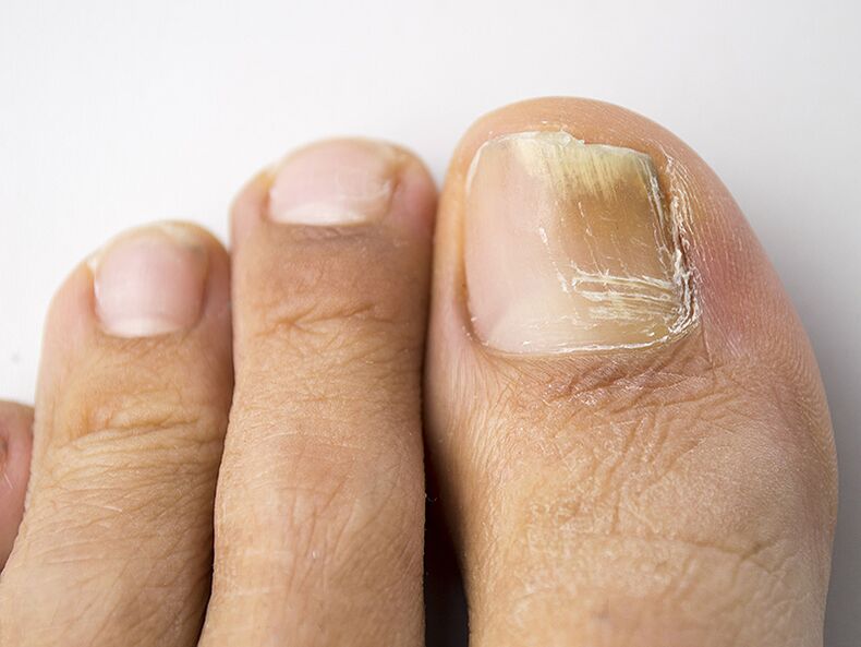 A gomba kezdeti szakasza