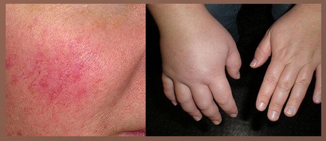 A cseppek mellékhatásai