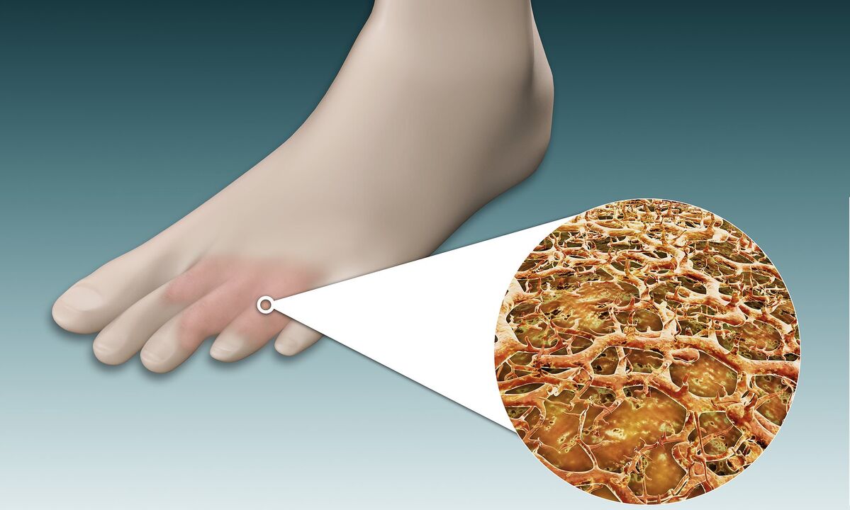 gombaspórák a lábon